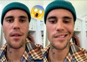 Justin Bieber tiene parálisis facial