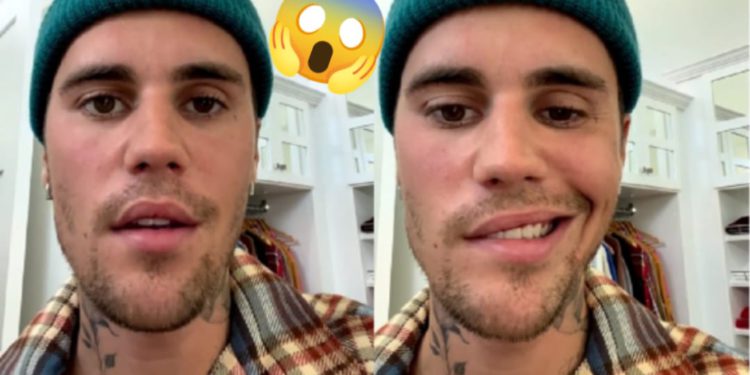 Justin Bieber tiene parálisis facial